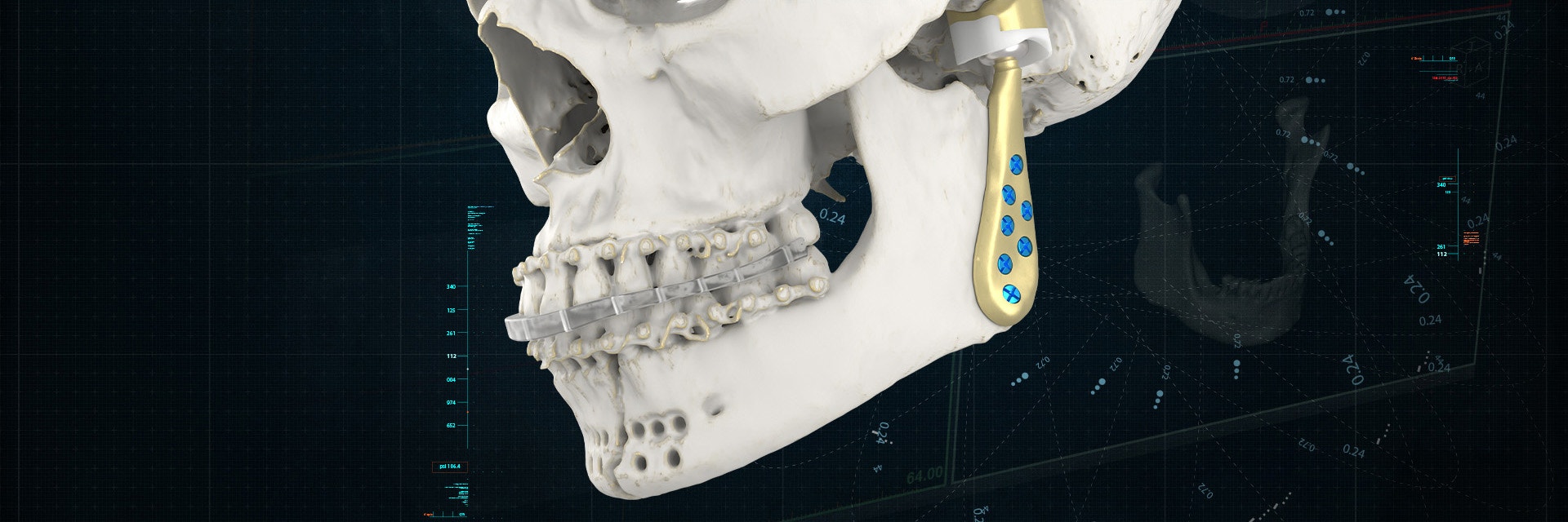 A skull model with a 3D-printed, personalized TMJ implant attached