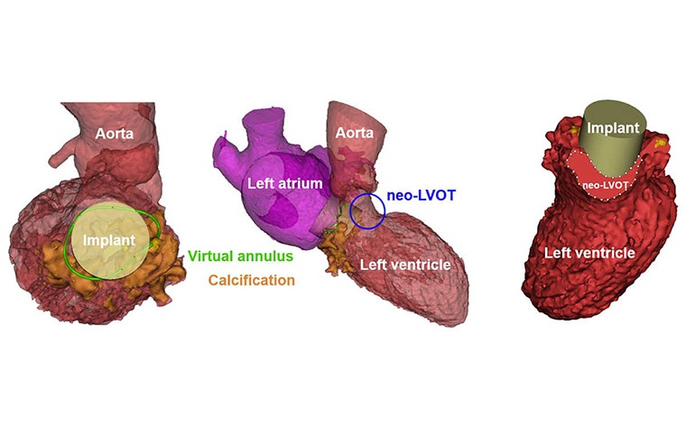 Image showing three TMVR planning models 