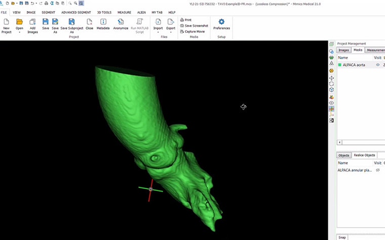 Screenshot of Materialise Mimics software being used to measure heart structure 