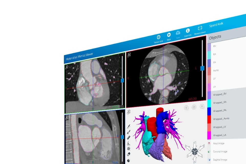 Écran montrant la visionneuse Mimics avec des radiographies et des images numériques d'un cœur