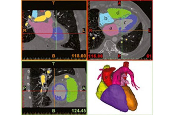 Verifying the fit of the articial heart in software