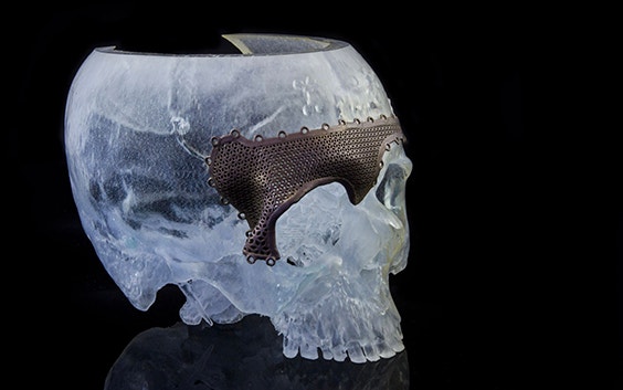 A 3D-printed human skull with cranial plate
