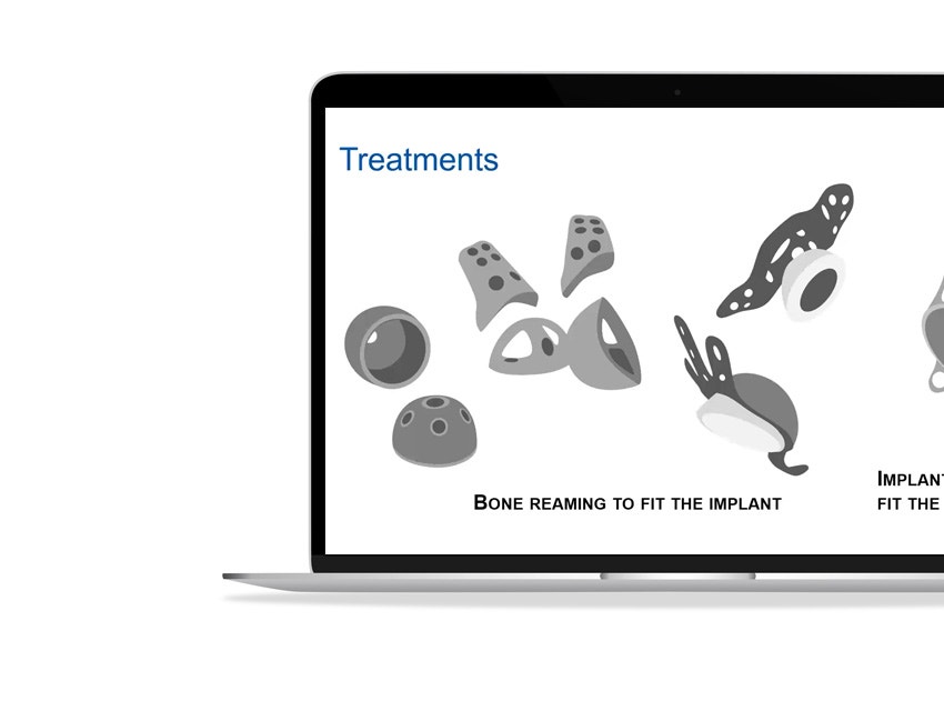 ssd-treatments-standard-and-personalized-implants.jpg