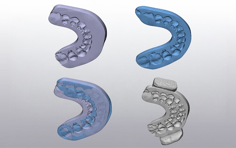 Four digital renderings of a dental model, showing progressive stages of refinement from a basic purple scan to a detailed grey 3D model with clearly defined teeth.