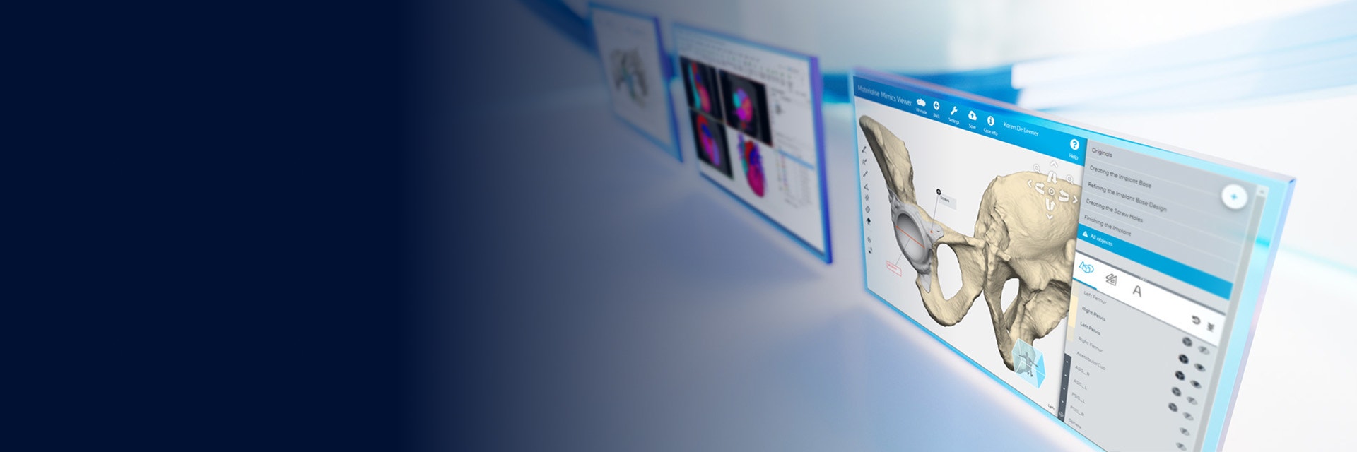Three screens showing patient anatomy within software from the Materialise Mimics platform on a white reflective background with blue lines