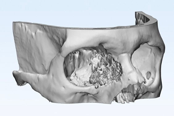 3D model of the skull with the tumor region