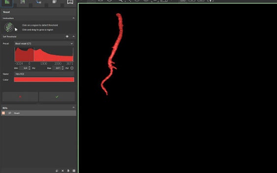 Captura de pantalla de una segmentación vascular