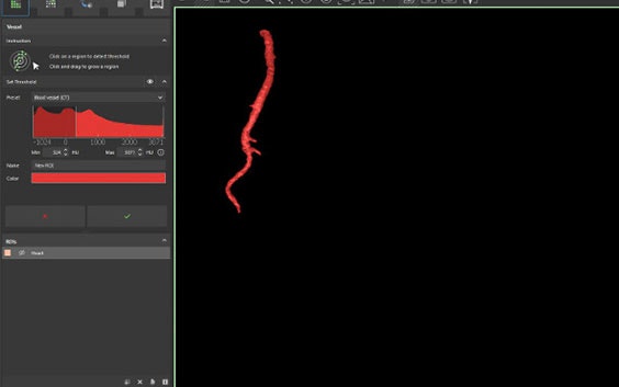 Screenshot of vascular segmentation