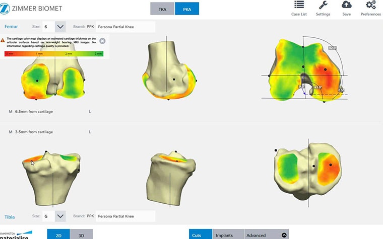 Various views of a knee bone in planning software