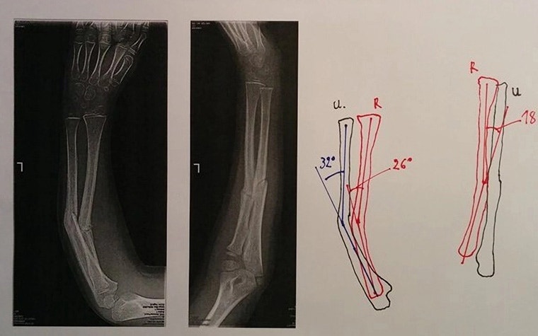팔 각도의 외과적 교정을 보여주는 도면 옆에 있는 부상당한 팔의 엑스레이 사진