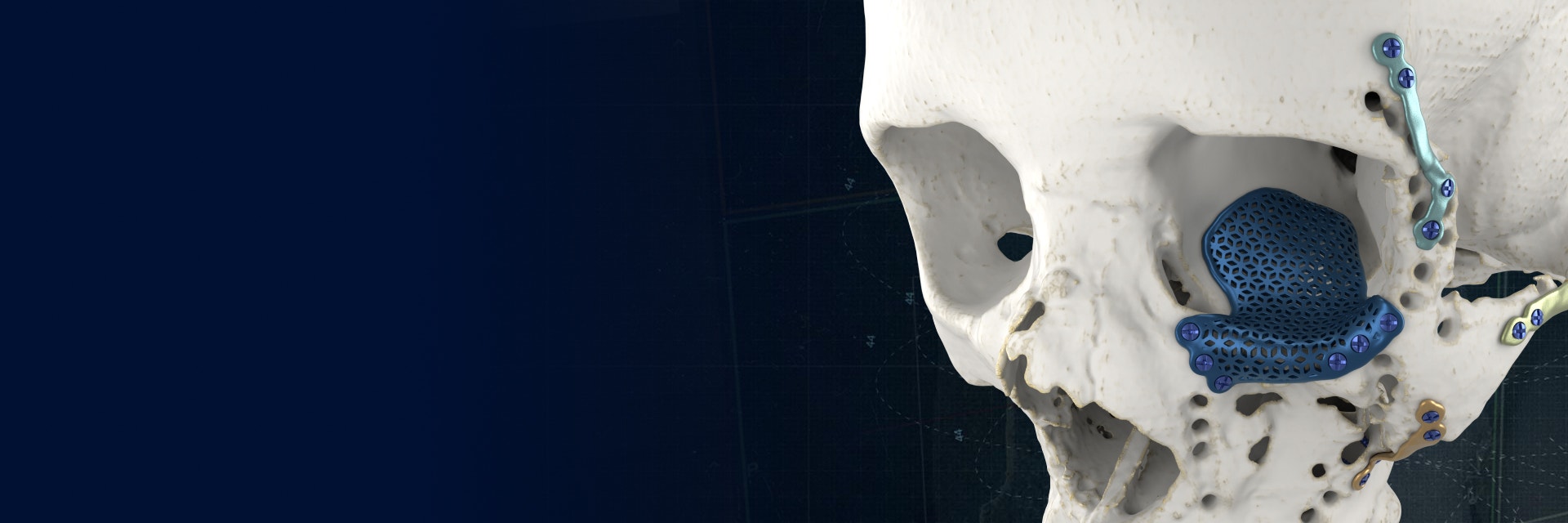 Modèle de crâne avec divers implants CMF imprimés en 3D en place