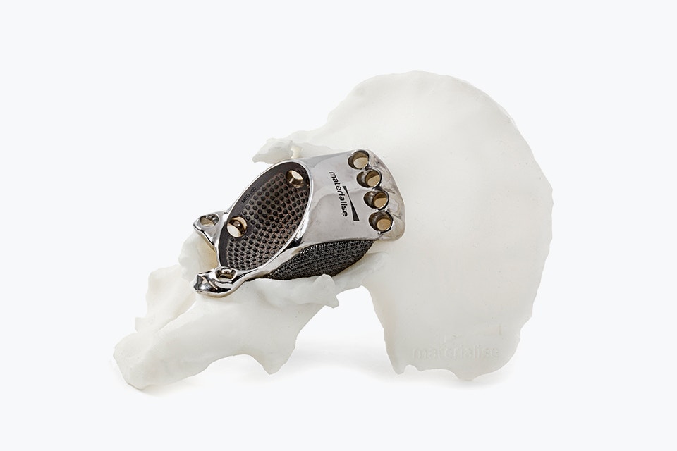 Implant imprimé en métal en 3D sur un modèle de hanche