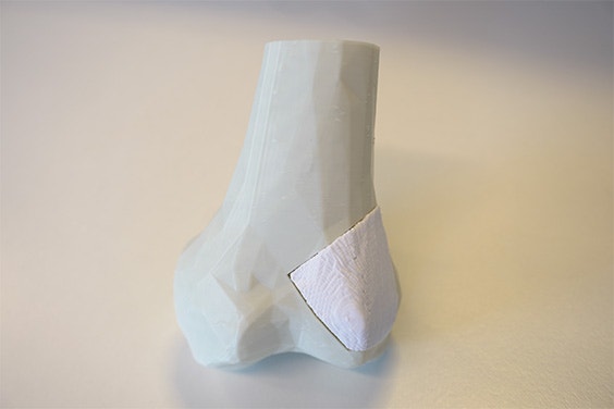 Final bone model with the 3D-printed bone implant perfect placed inside