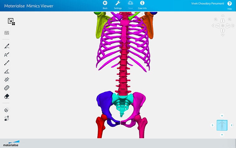 Screenshot of Materialise Mimics Viewer showing segmented should, torso, hip, and upper leg anatomy