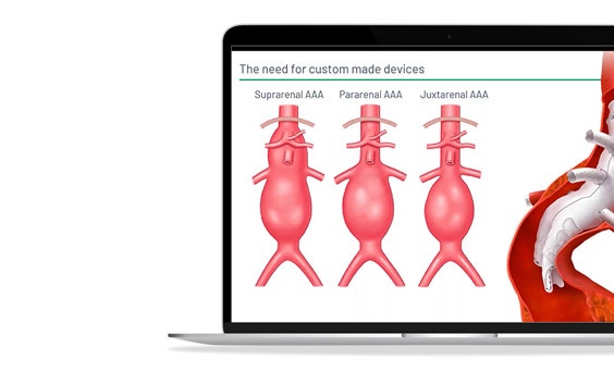 ssm-terumo-aortic-custom-devices.jpg