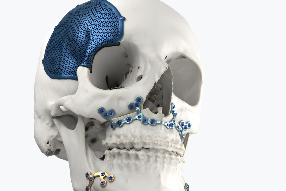 Schädelmodell mit 3D-gedruckten befestigten Implantaten