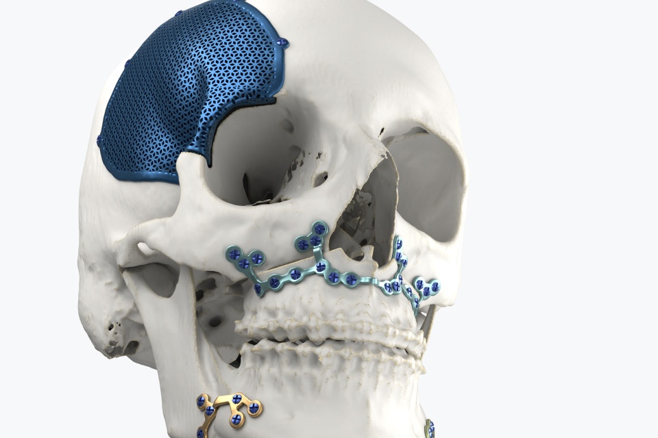 Modèle de crâne avec des implants imprimés en 3D fixés