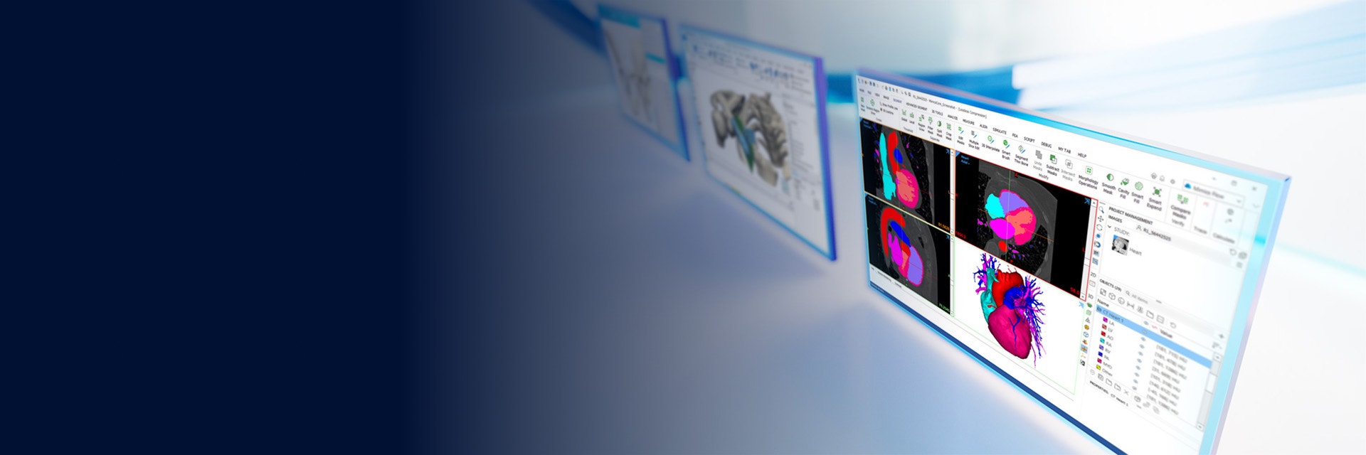 Drei Bildschirme, die die Anatomie des Patienten in der Software der Materialise Mimics-Plattform auf einem weißen, reflektierenden Hintergrund mit blauen Linien zeigen