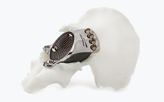 Implante metálico impreso en 3D en un modelo de cadera