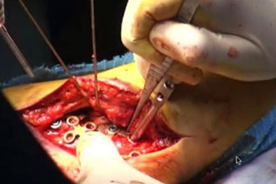 Image of the surgical guide in the patient during the operation