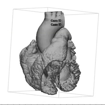 How to Create a Heart Model in Materialise Mimics for 3D Printing