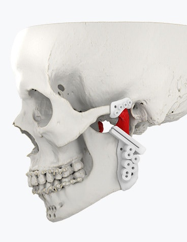 Digital render of 3D-printed surgical guides on a skull
