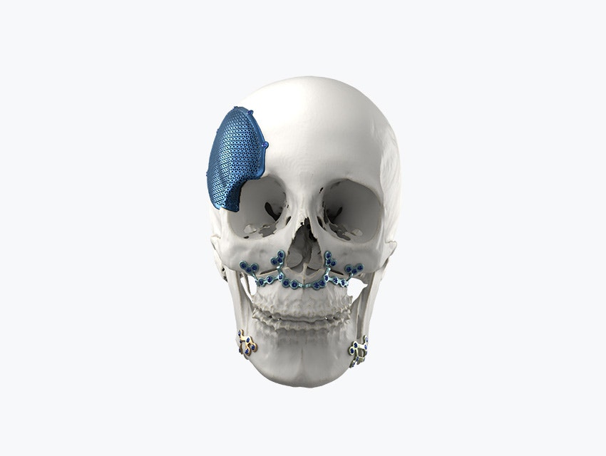Model of a skull with metal, personalized implants attached