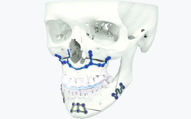 3Dプリンターで作成した手術ガイドを取り付けた人体頭蓋骨モデル