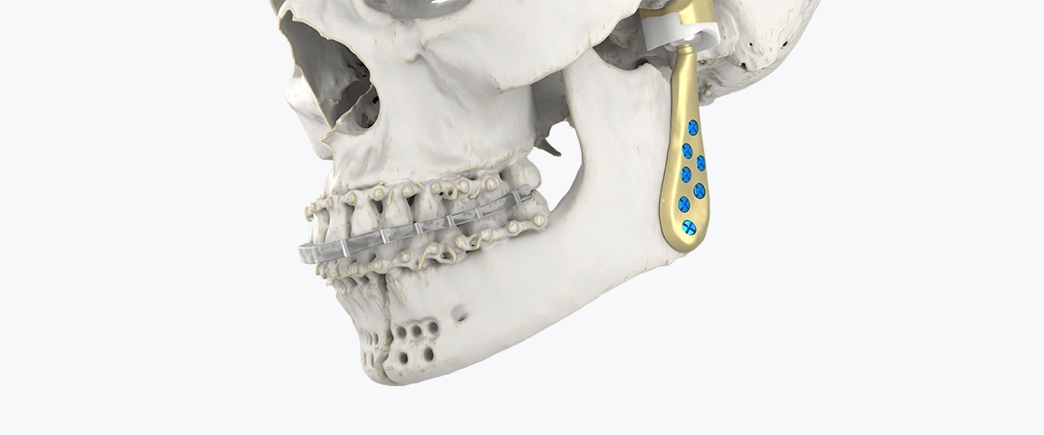 Lower half of a skull model with the TMJ Total Arthroplasty System attached