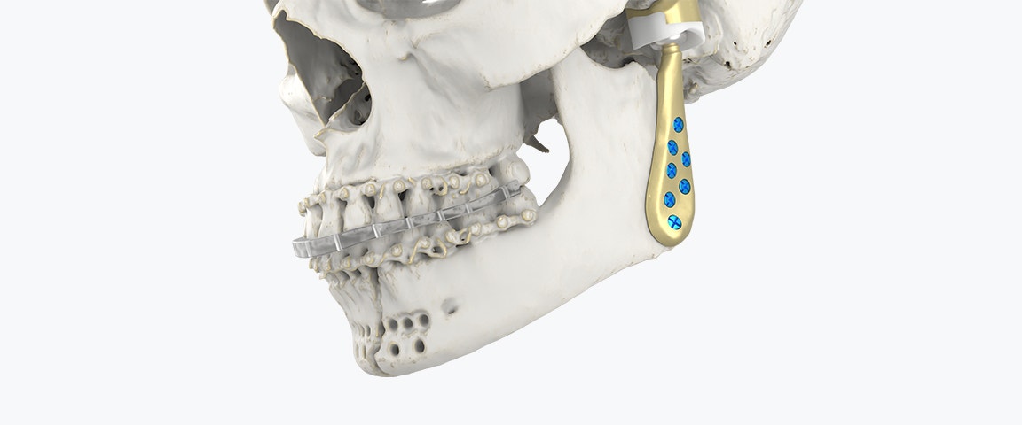Untere Hälfte eines Schädelmodells mit befestigtem Kiefergelenk-Totalendoprothesen-System