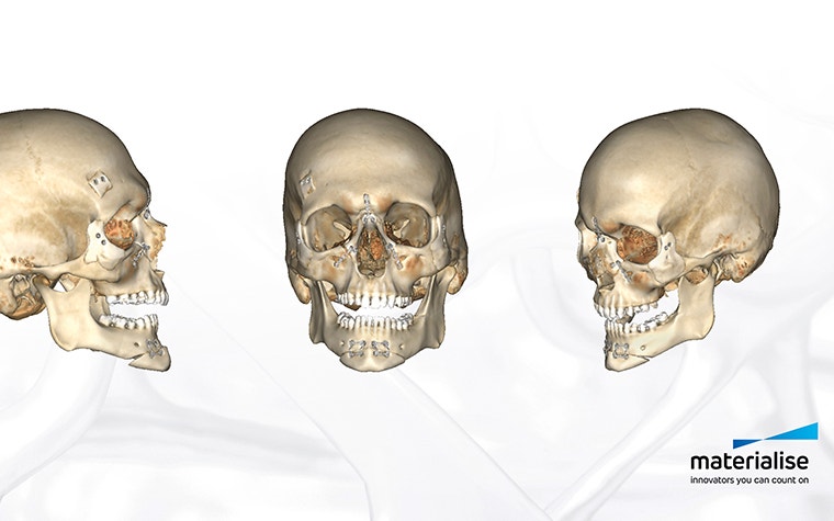 3D models of three skulls