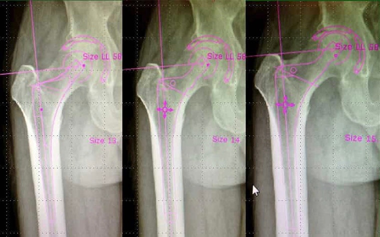 Comparing implant sizes in OrthoView. 