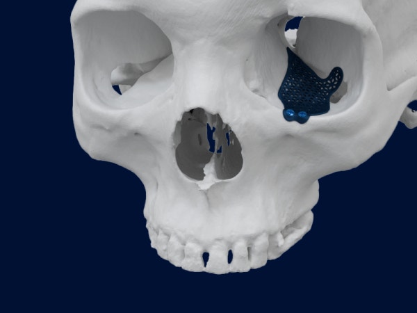 Model of a skull with a 3D-printed, personalized orbital implant attached