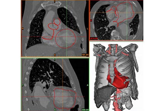 Tools being applied  to the images of anatomy, such as thresholding, region growing and morphological operations