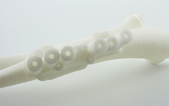 3D-printed surgical guide 