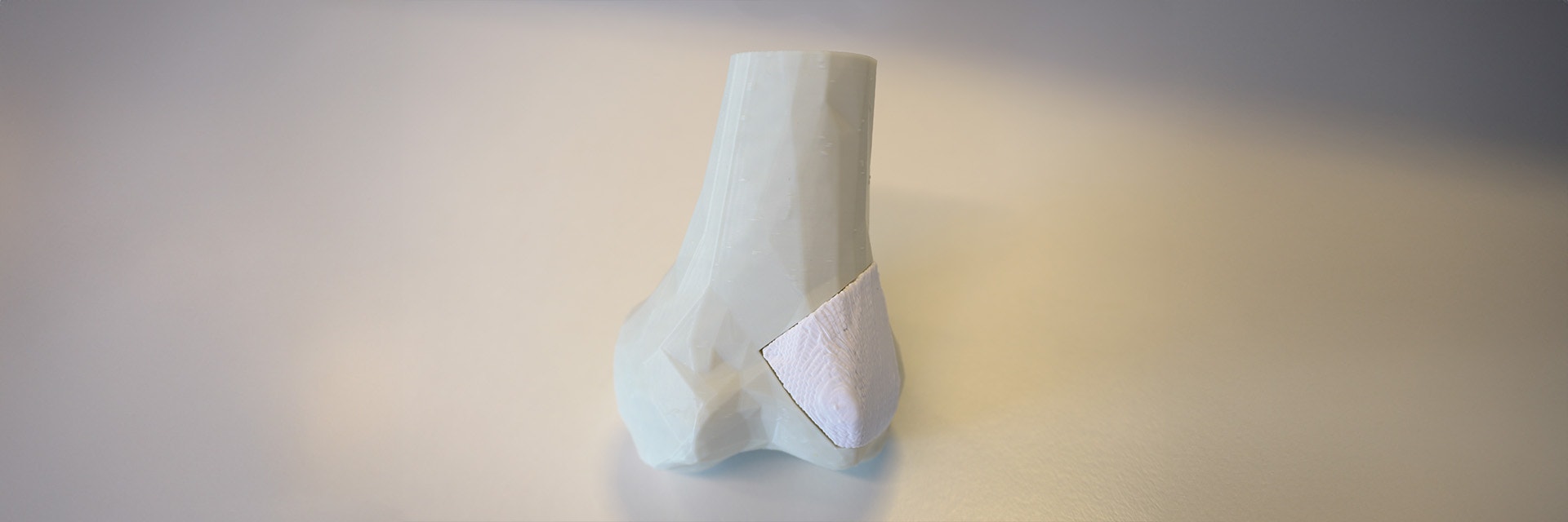 Final bone model with the 3D-printed bone implant perfect placed inside
