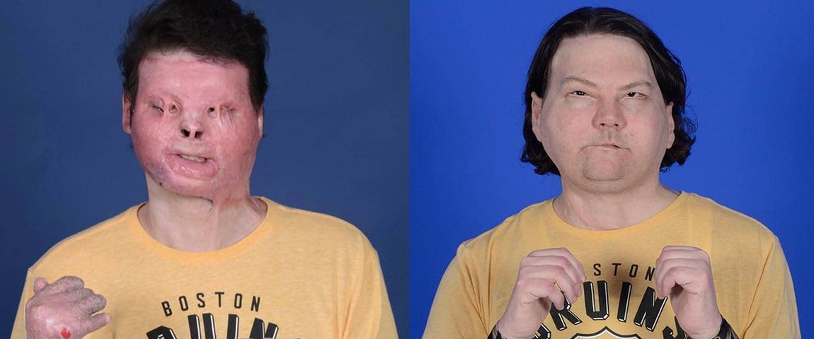Two pictures of the same man before and after his double hand and face transplant surgery 