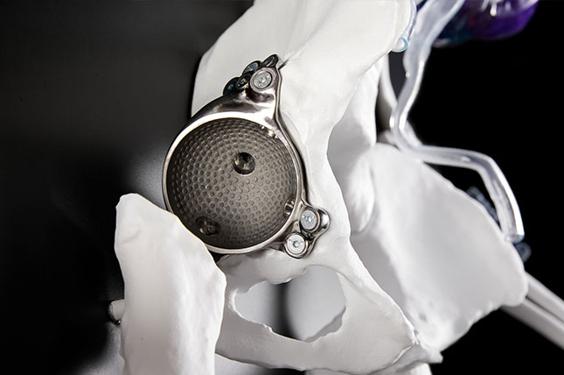 3D-printed implant in a model hip bone