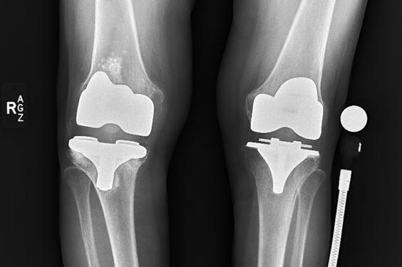 Pre-op X-ray image of a patient's knees