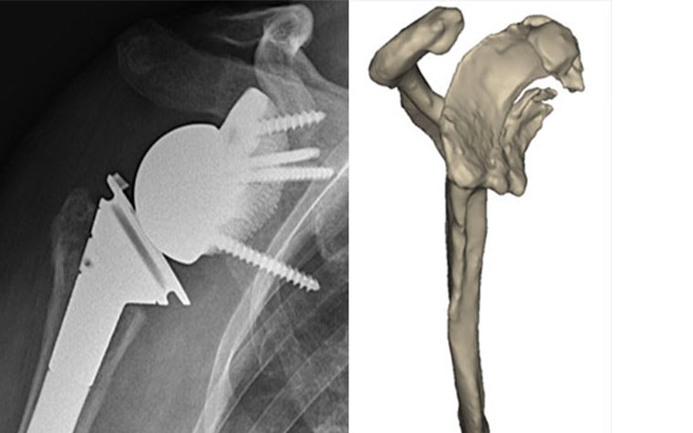 X-ray showing a 3D-printed shoulder implant next to a digital 3D model of the shoulder