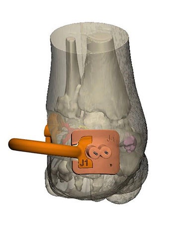 Digital model of a foot with a personalized instrument attached at the ankle, viewed from the back