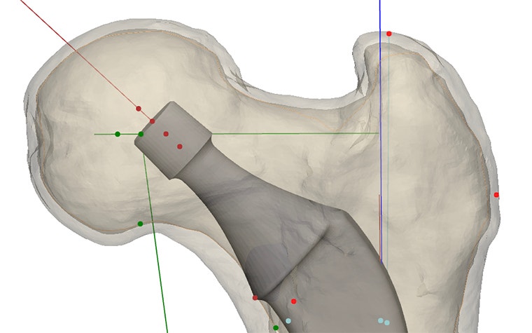 Close-up of virtually implanted femoral stems 