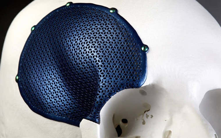 3D-printed titanium implant for craniomaxillofacial surgery   