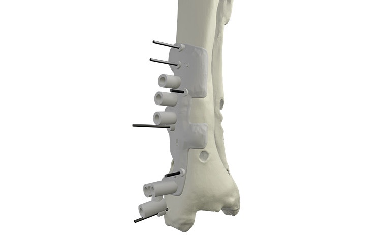 materialise-osteotomies-solutions-3d-printed-guides-indication-ankle-model.jpg