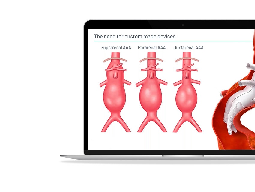 ssd-terumo-aortic-custom-devices.jpg