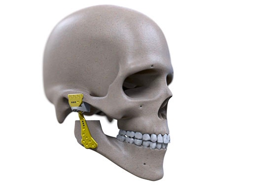 Skull model with a CMF implant on its jaw