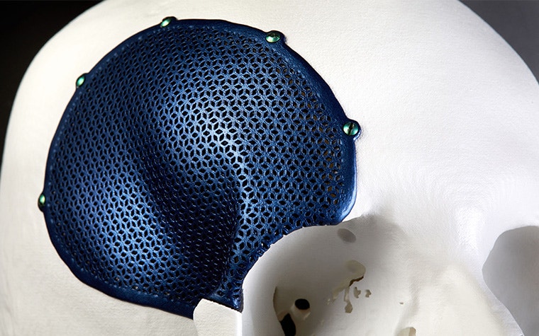 A 3D-printed, porous, titanium CMF implant shown on a skull.