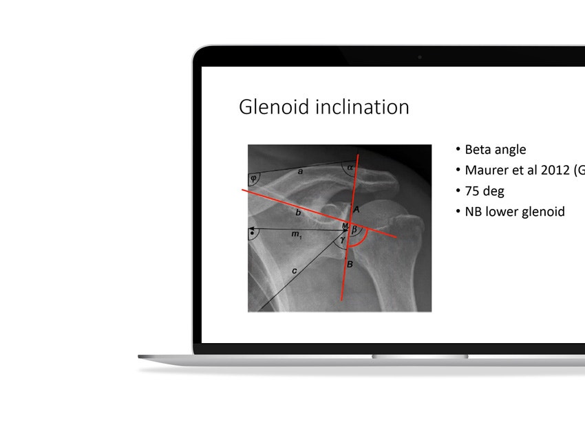 ssd-glenoid-inclination.jpg