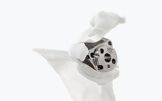 3D-printed Glenius shoulder implant in a shoulder model