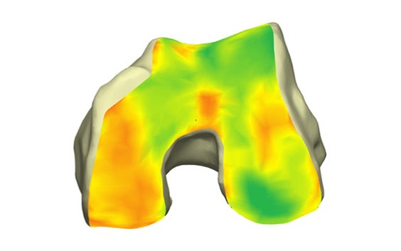 Cartilage color map on a bone